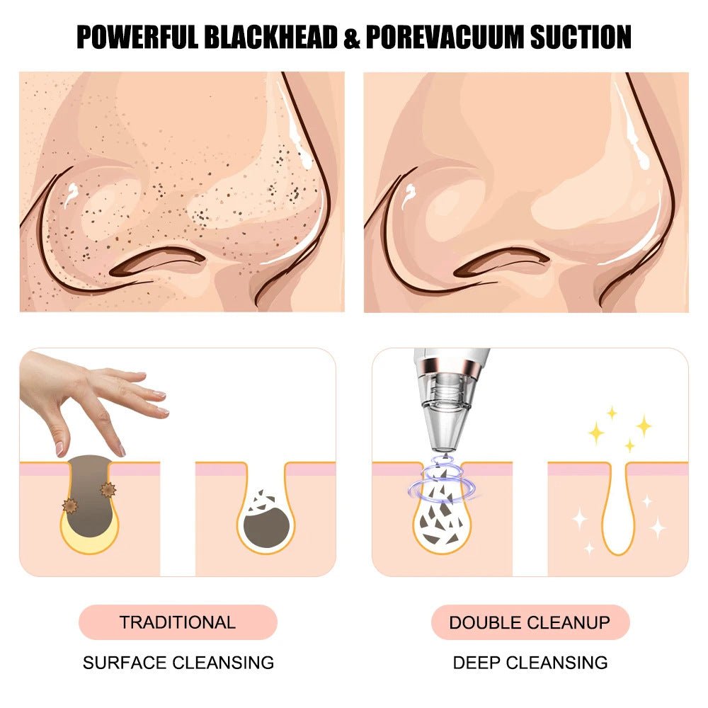 New electric blackhead removal and pore cleaning for blackheads - Tower Exclusives